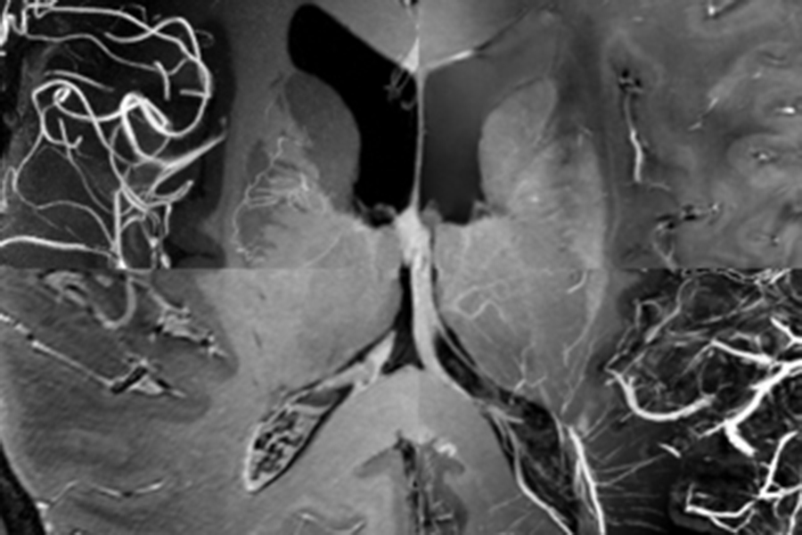 Die Überlagerung von mehreren ultra-hochaufgelösten MRT-Kontrasten zeigt die Anatomie und Gefäßversorgung des menschlichen Hirns (c) Falk Lüsebrink / Universität Magdeburg.