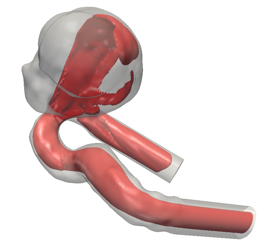 Illustration of flow field in a patient-specific intra-cranial aneurysm geometry. Simulation performed using ALBORZ by M.Sc. Feng Huang (currently Ph.D. student at the LSS).